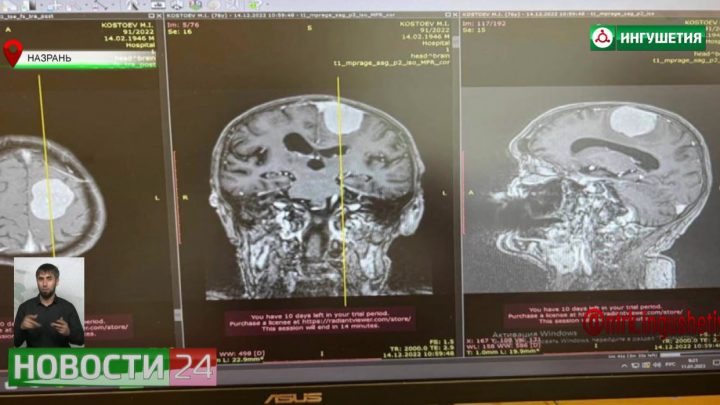 Нейрохирурги ИРКБ выполнили уникальную операцию по удалению опухоли головного мозга