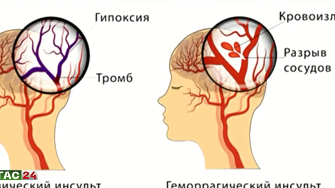 Всемирный день борьбы с инсультом.