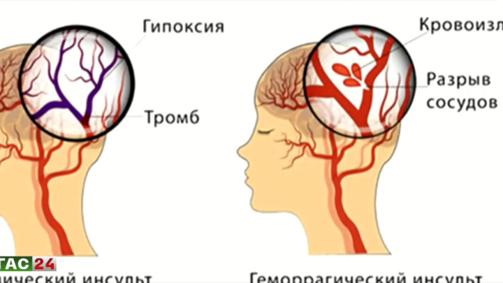 Всемирный день борьбы с инсультом.